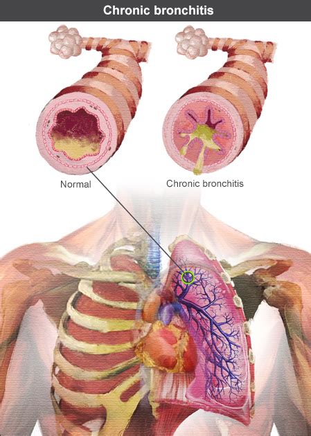 Chronic Bronchitis Clinical Features Respe
