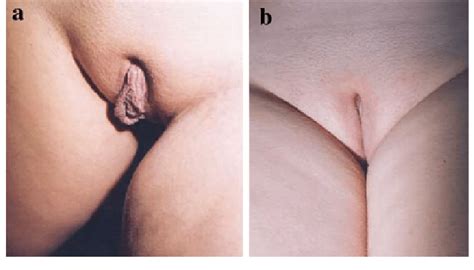 Before A And After B Photos Of Vaginal Labioplasty 17