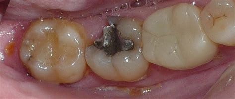 broken teeth beverly restorative  implant dentistry center