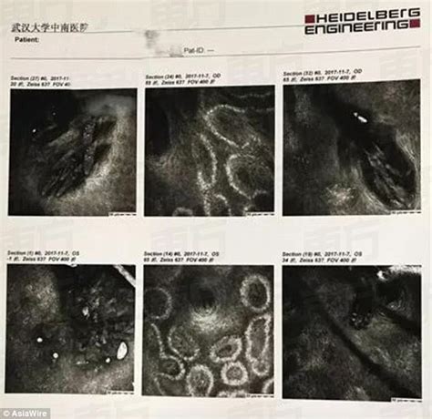 woman s eyelashes infested with 100 parasites after not washing pillowcase for 5 years the