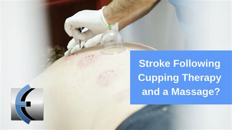 Stroke Following Cupping Therapy And A Massage What