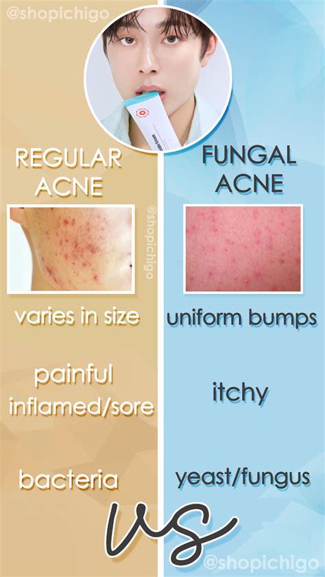 fungal acne fungal acne treatments triggers  safe products