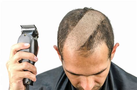 balding clippers hold  hairline