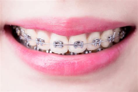 braces and orthodontics nhs