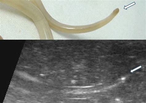Intestinal Nematode Ascaris Lumbricoides Radiology Case