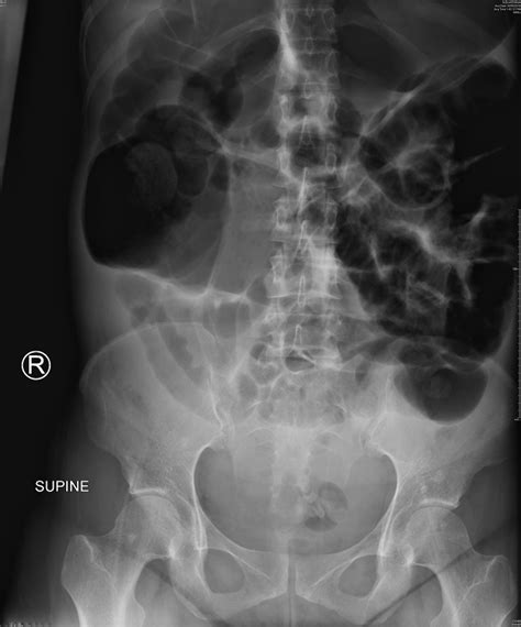 An Obstetric Perspective On Functional Bowel Obstruction