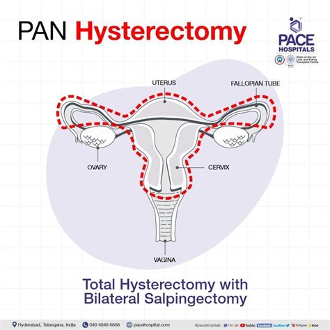 Hysterectomy Surgery In Hyderabad Indications Side Effects And Cost