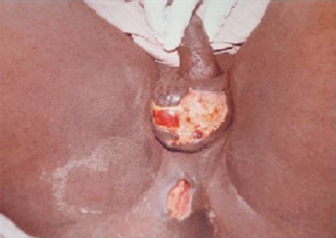 healing of anal fistula porn galleries