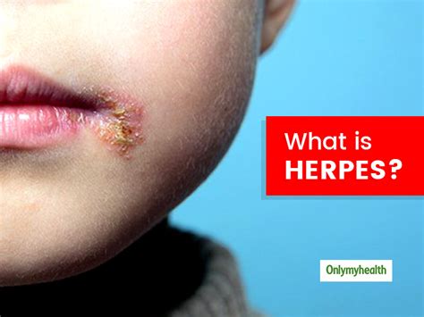 what is herpes know its types causes signs and
