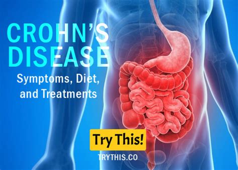 crohn s disease symptoms diet and treatments health