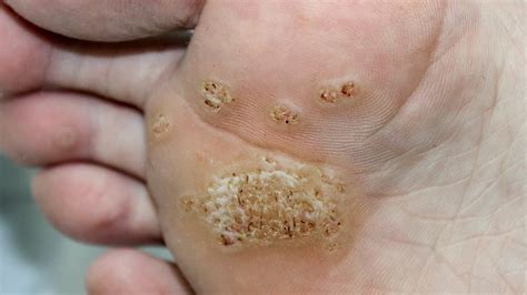 warts types images treatment