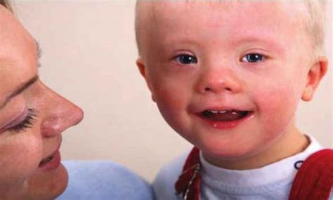 Pengertian Down Syndrome Gejala Penyebab Dan Pengobatannya