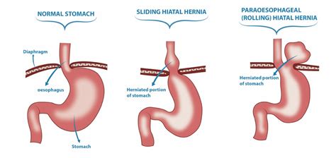 size   small hiatal hernia