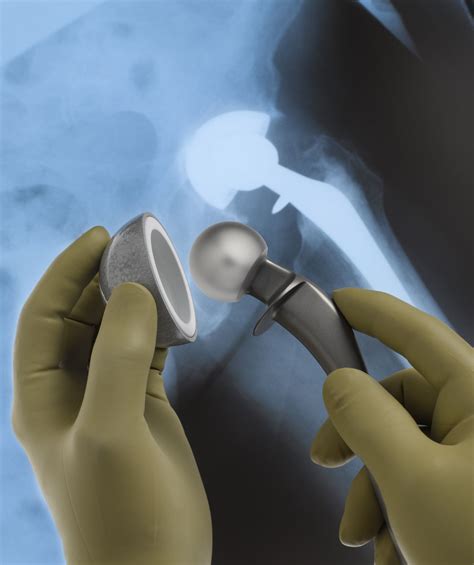 hip replacement surgery   expect   day  surgery