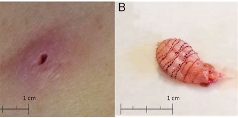 Woman Finds A Human Botfly Larva Burrowed Into Skin