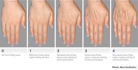 do your hands give away your age dr monica scheel dermatology
