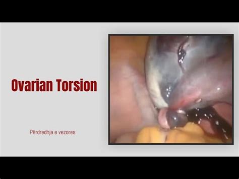 torsion ovarian youtube