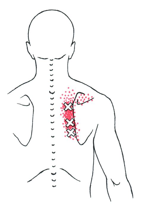 rhomboid  trigger point referred pain guide