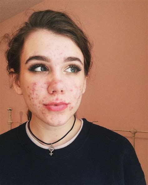 Pin By Anita Life On Acne Positivity ️ Girl With Acne Bare Beauty