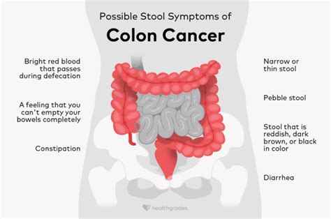 colon cancer stool signs  symptoms