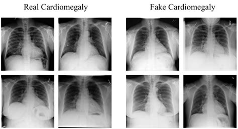 Real And Fake X Ray Images With Cardiomegaly Download Scientific Diagram
