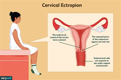 Cervical Ectropion Symptoms Causes Treatment