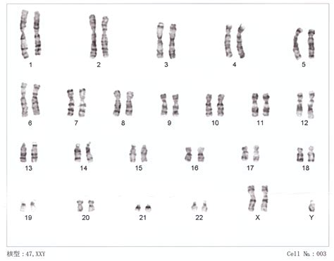 Klinefelter Syndrome Wikipedia