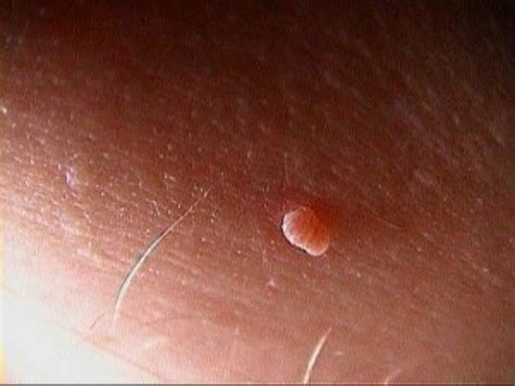 is there a difference between skin tags and warts