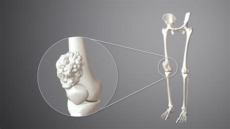 bone cancer types symptoms   treatment scientific animations