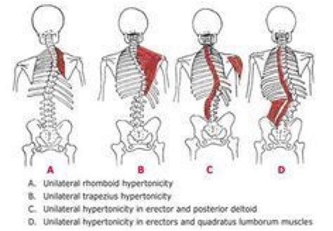 Functional Scoliosis Psoastriggerpoints Scoliosis
