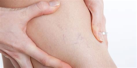 5 Ways To Hide Varicose Veins