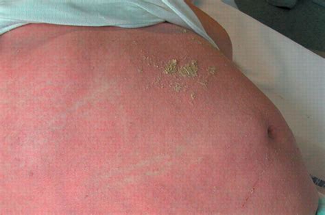 scabies diagnosis and treatment the bmj