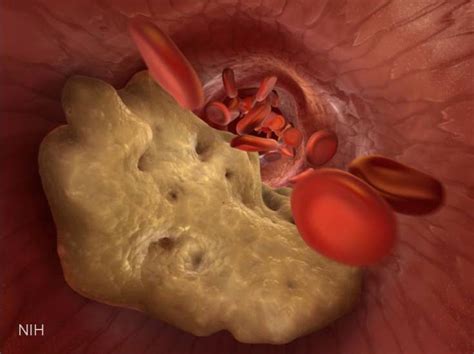 microrna research takes aim  cholesterol nih directors blog