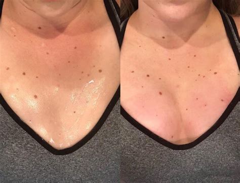 the vampire breast lift procedure in ohio great skin ohio