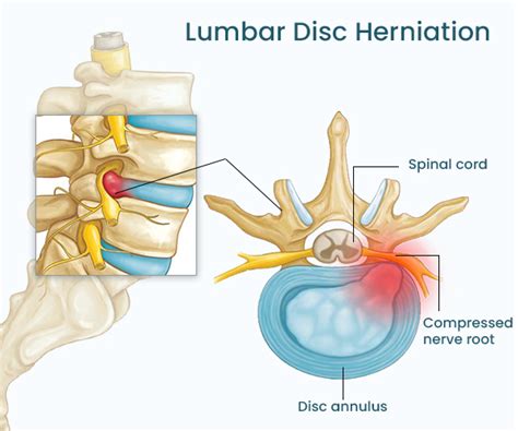 herniated disc treatment specialists nj  nyc herniated disc surgery   jersey