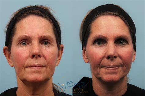 face lift neck lift    patient  vancouver bc  medspa cosmetic
