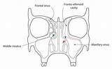 Sinus Surgery Endoscopic Paranasal Recess Sinuses Sphenoethmoidal Into Ethmoidal Drain Posterior Drainage Submucosal Smr Resection Septoplasty Superior sketch template