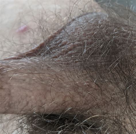 what is this formation on my penis hpv ingrown hair herpes