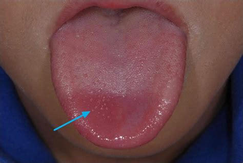 transient lingual papillitis or lie bumps causes and lie bumps treatment