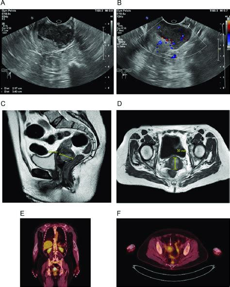 imaging tests of the uterine cervix a and b the ultrasound scanning