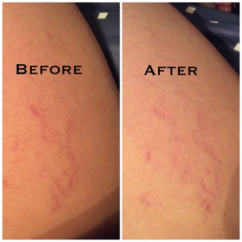 cerave intensive stretch marks cream reviews in cellulite