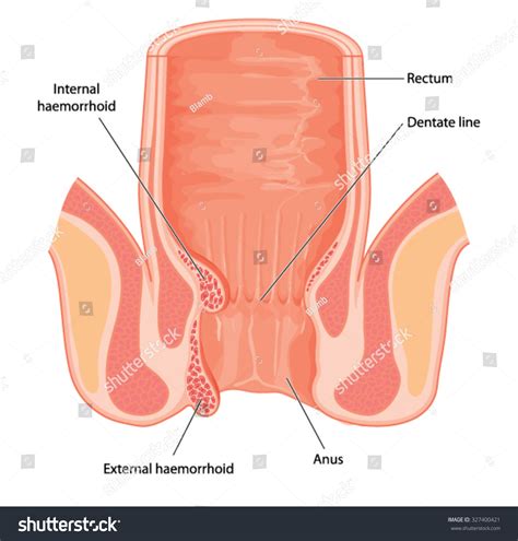 anal fistula and hiv brunette