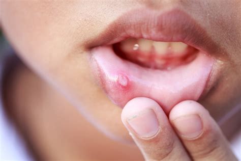 Emergency Dentist Talks About Distinguishing Canker Sores