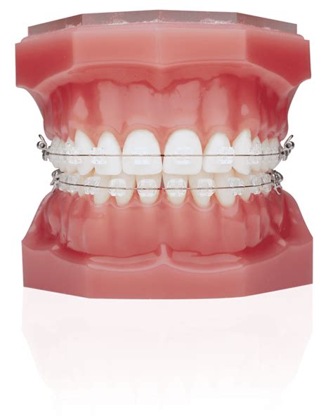 ice clear ceramic braces   orthodontics