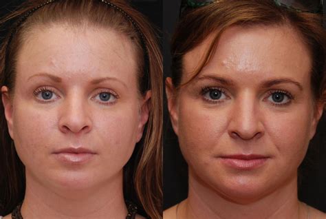 facial liposuction  cincinnati  patient