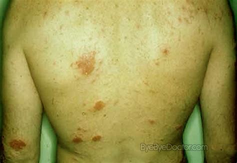 Nummular Dermatitis Pictures Causes Treatment