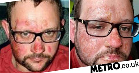 Magician Left With Burns After Aromatherapy Kit Set His Face On Fire
