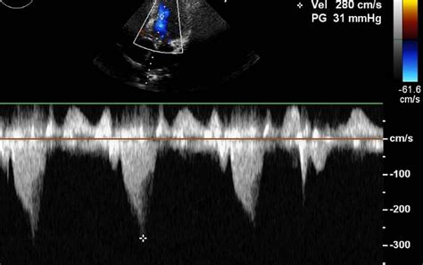 lvot gradient  hocm doppler echocardiogram   cardiovascular system  disorders