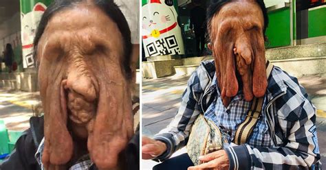 Woman With Rare Melting Face Condition Refuses Surgery