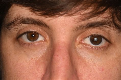 story   eye  cataract surgery